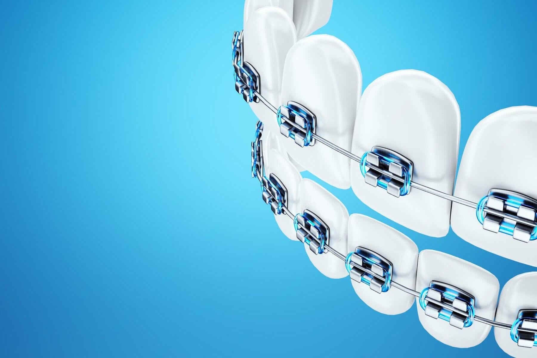 How-Should-Patients-with-Braces-Properly-Brush-Their-Teeth RANVOO